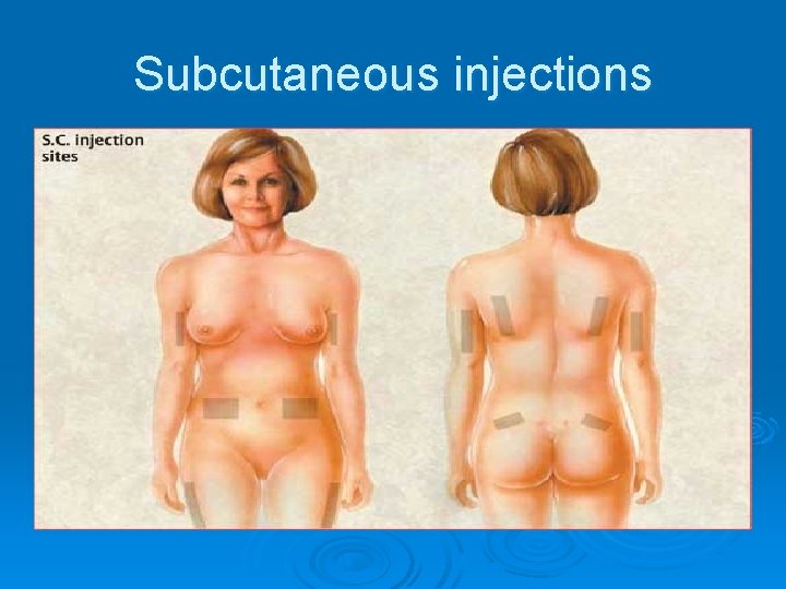 Subcutaneous injections 