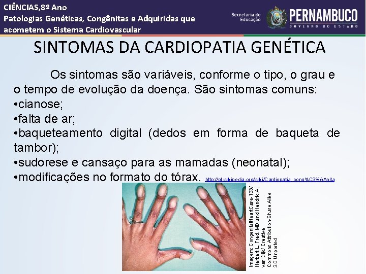 CIÊNCIAS, 8º Ano Patologias Genéticas, Congênitas e Adquiridas que acometem o Sistema Cardiovascular SINTOMAS