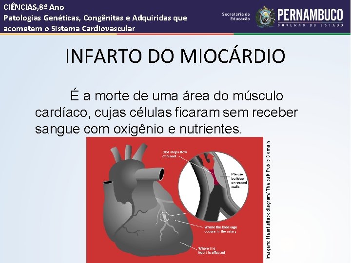 CIÊNCIAS, 8º Ano Patologias Genéticas, Congênitas e Adquiridas que acometem o Sistema Cardiovascular INFARTO