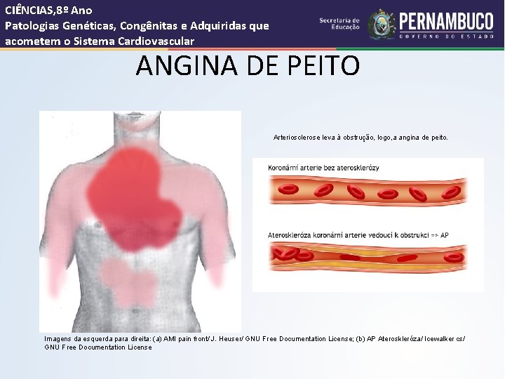 CIÊNCIAS, 8º Ano Patologias Genéticas, Congênitas e Adquiridas que acometem o Sistema Cardiovascular ANGINA