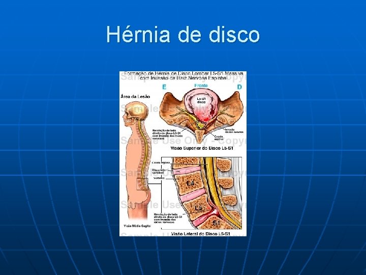 Hérnia de disco 