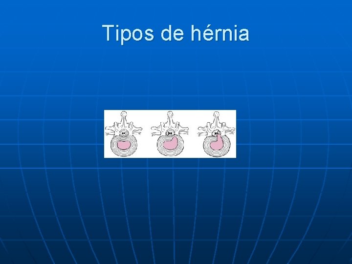 Tipos de hérnia 