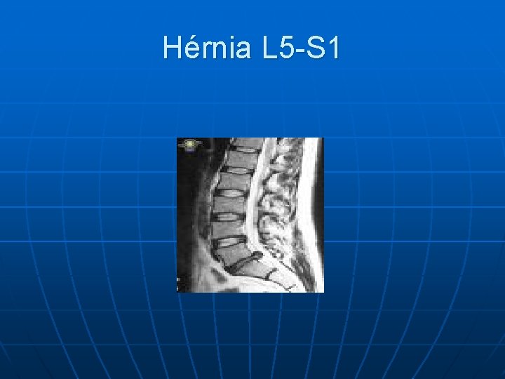 Hérnia L 5 -S 1 