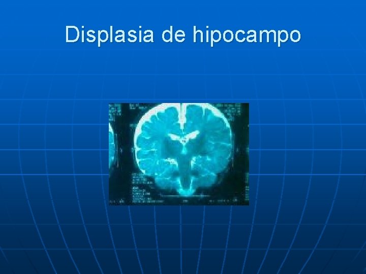 Displasia de hipocampo 