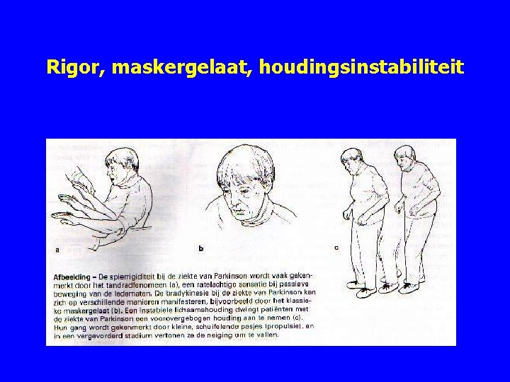 Rigor, maskergelaat, houdingsinstabiliteit 