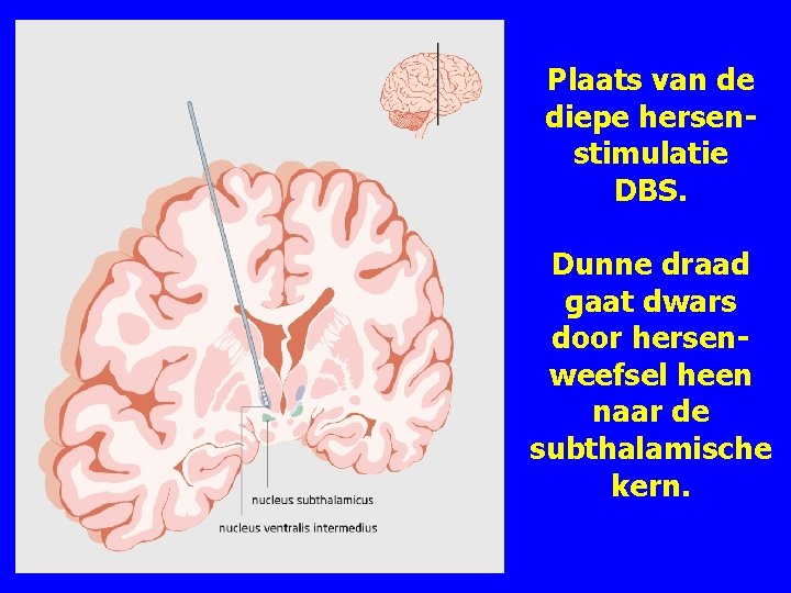 Plaats van de diepe hersenstimulatie DBS. Dunne draad gaat dwars door hersenweefsel heen naar