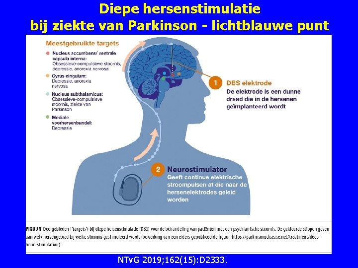 Diepe hersenstimulatie bij ziekte van Parkinson - lichtblauwe punt NTv. G 2019; 162(15): D