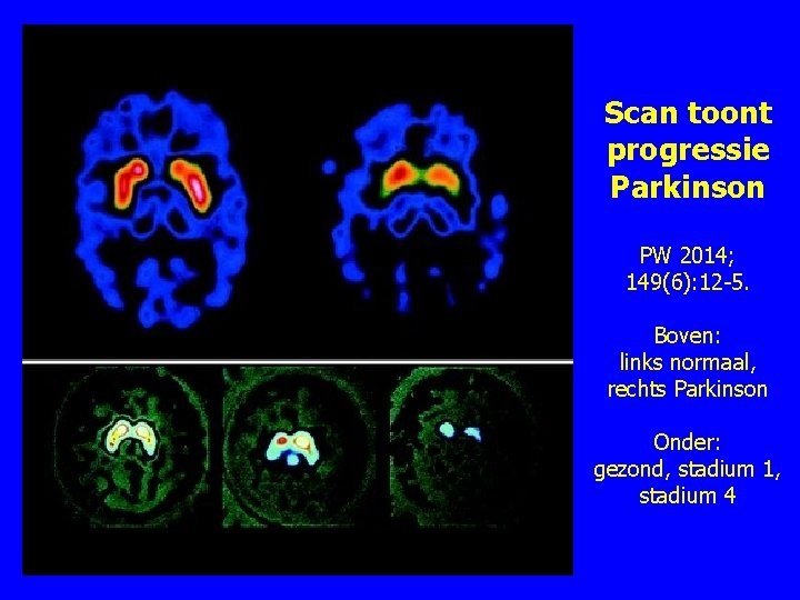 Scan toont progressie Parkinson PW 2014; 149(6): 12 -5. Boven: links normaal, rechts Parkinson