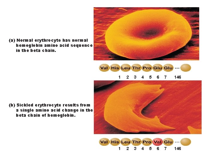 (a) Normal erythrocyte has normal hemoglobin amino acid sequence in the beta chain. 1