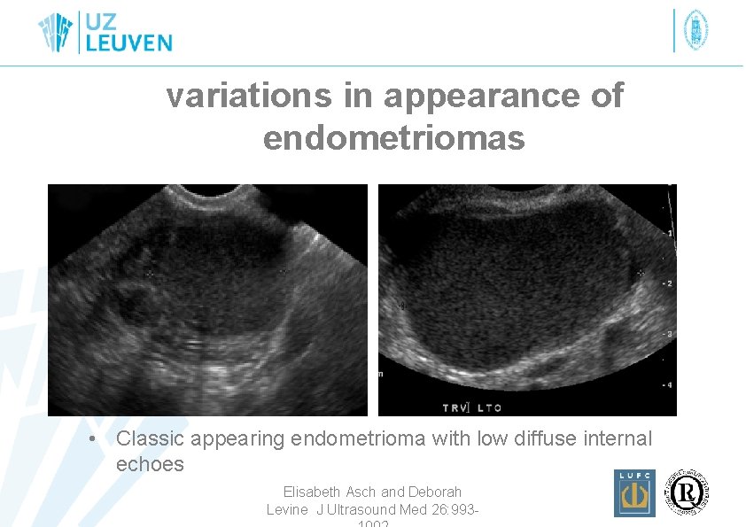 variations in appearance of endometriomas • Classic appearing endometrioma with low diffuse internal echoes