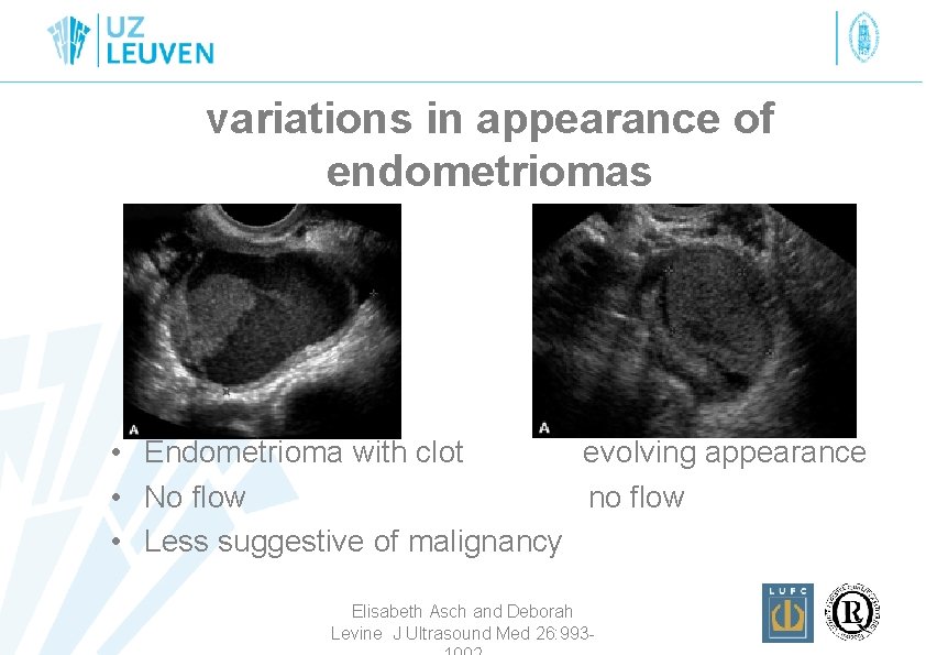 variations in appearance of endometriomas • Endometrioma with clot evolving appearance • No flow