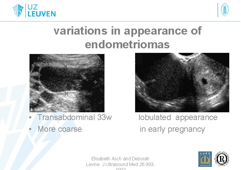 variations in appearance of endometriomas • Transabdominal 33 w • More coarse lobulated appearance