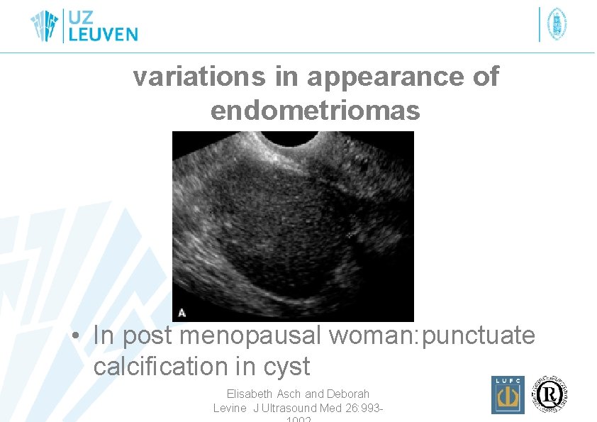 variations in appearance of endometriomas • In post menopausal woman: punctuate calcification in cyst