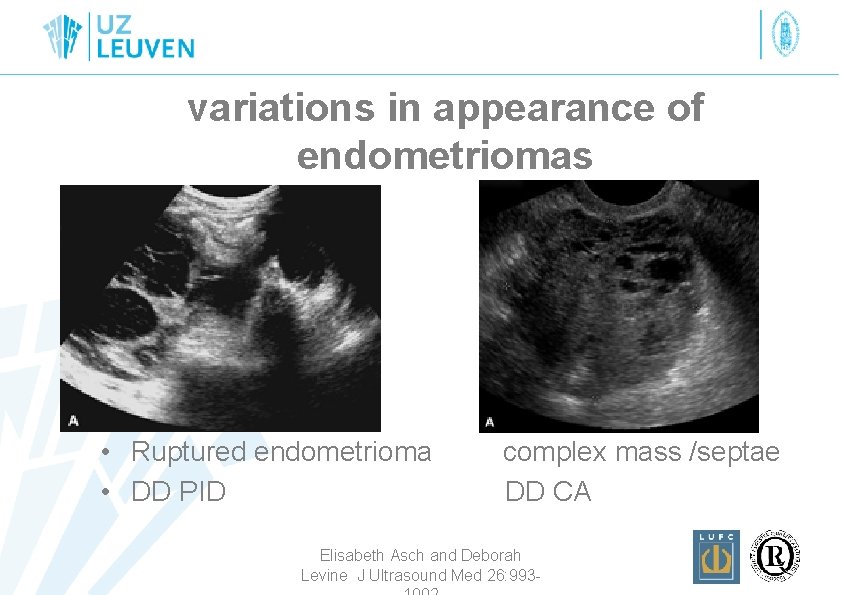 variations in appearance of endometriomas • Ruptured endometrioma • DD PID complex mass /septae