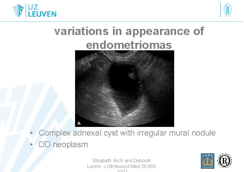 variations in appearance of endometriomas • Complex adnexal cyst with irregular mural nodule •