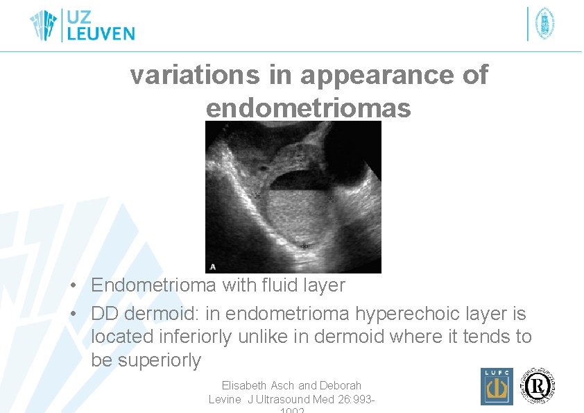 variations in appearance of endometriomas • Endometrioma with fluid layer • DD dermoid: in