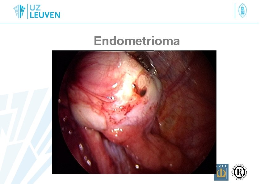 Endometrioma 