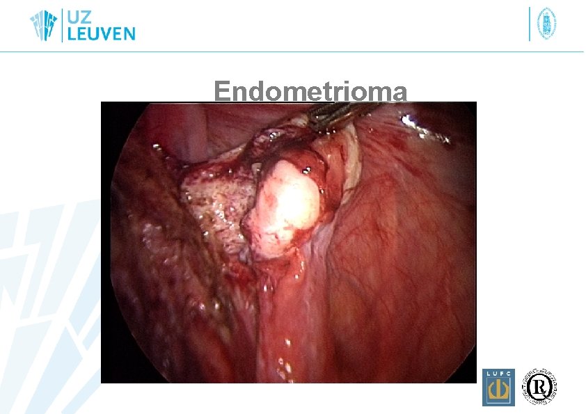 Endometrioma 