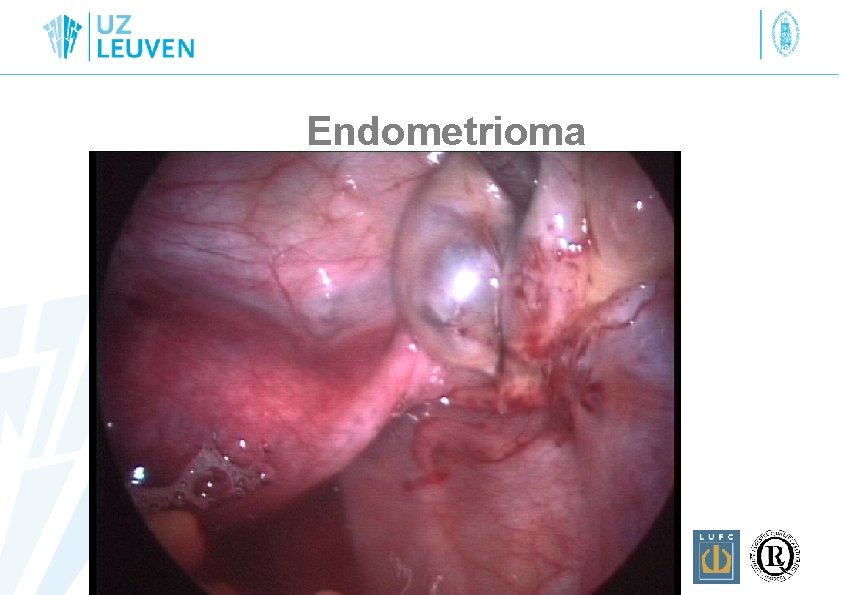 Endometrioma 