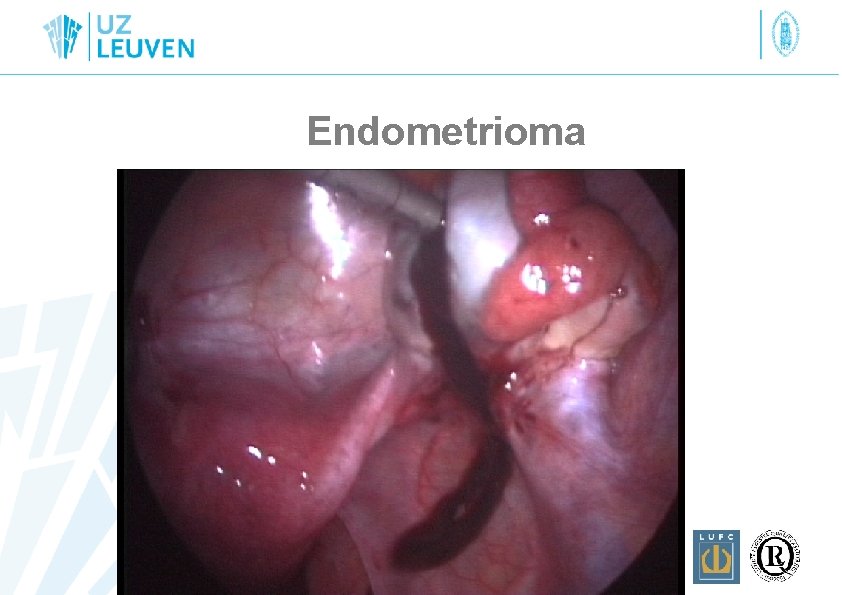 Endometrioma 