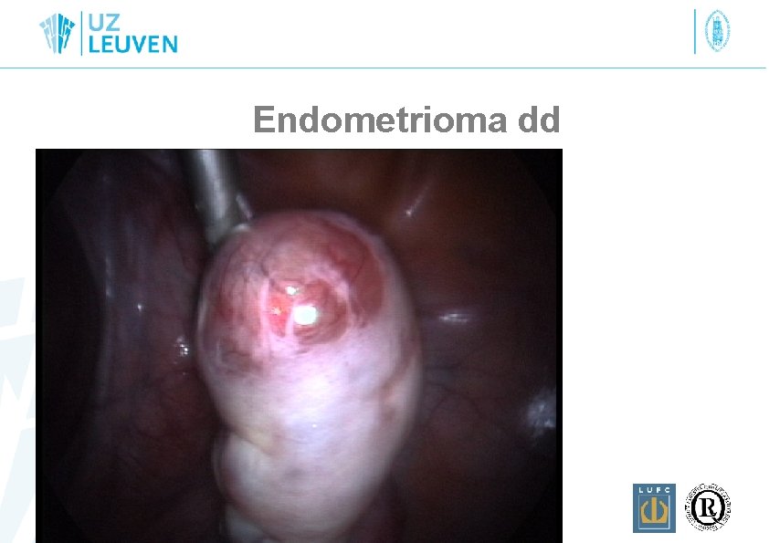 Endometrioma dd 