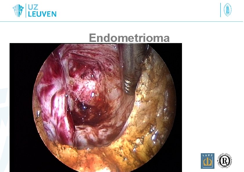 Endometrioma 
