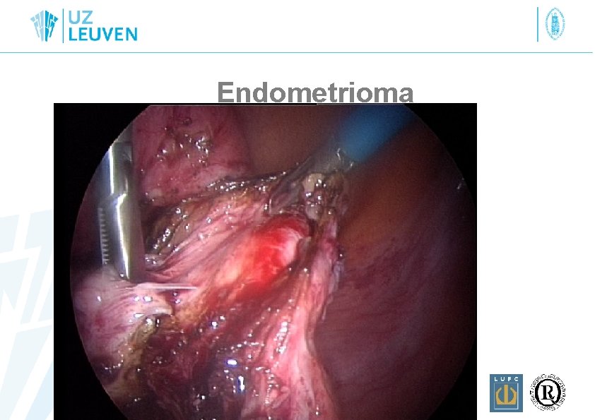 Endometrioma 