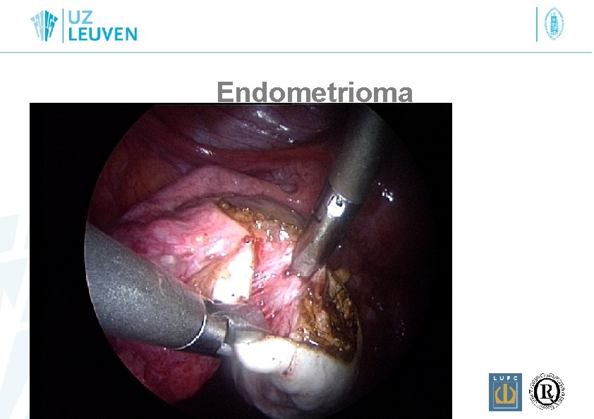 Endometrioma 