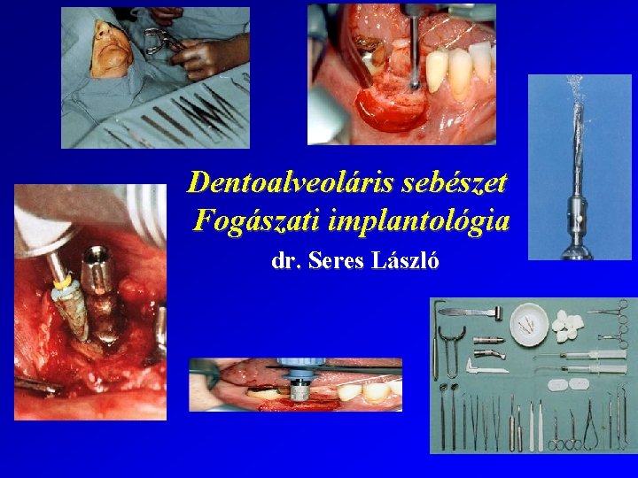 Dentoalveoláris sebészet Fogászati implantológia dr. Seres László 