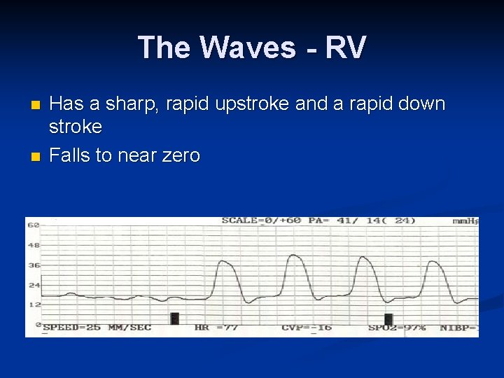 The Waves - RV n n Has a sharp, rapid upstroke and a rapid