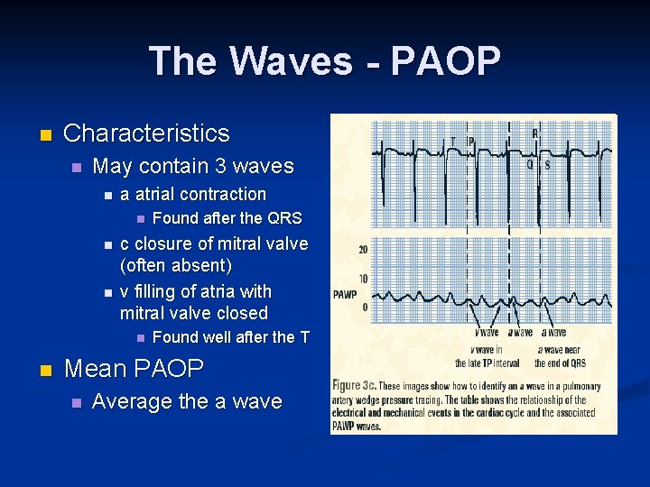 The Waves - PAOP n Characteristics n May contain 3 waves n a atrial