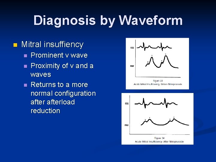 Diagnosis by Waveform n Mitral insuffiency n n n Prominent v wave Proximity of