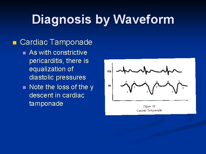 Diagnosis by Waveform n Cardiac Tamponade n n As with constrictive pericarditis, there is
