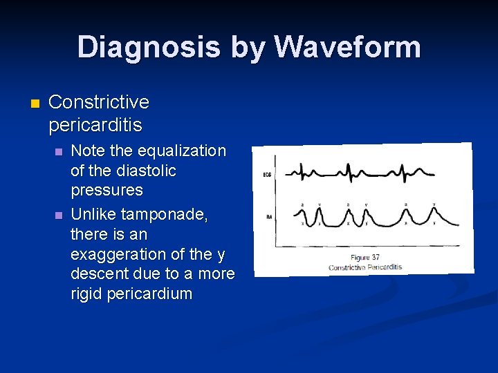 Diagnosis by Waveform n Constrictive pericarditis n n Note the equalization of the diastolic