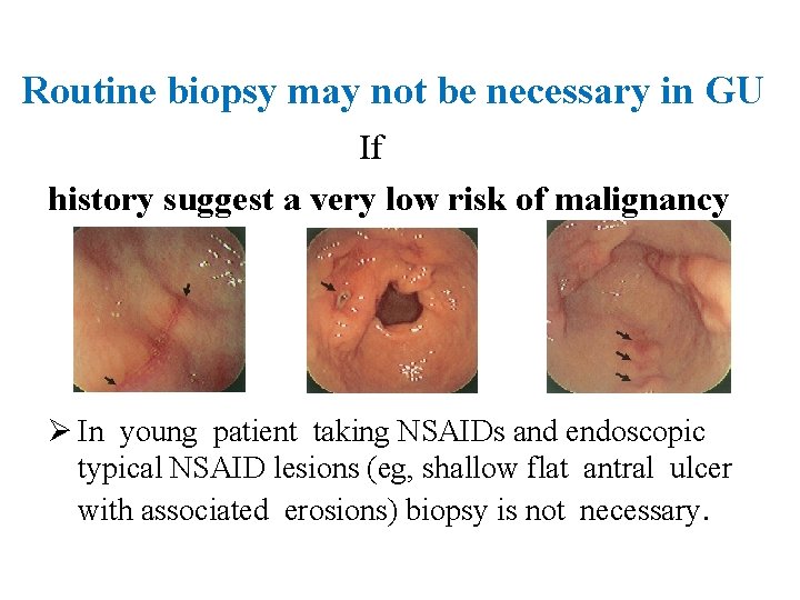 Routine biopsy may not be necessary in GU If history suggest a very low