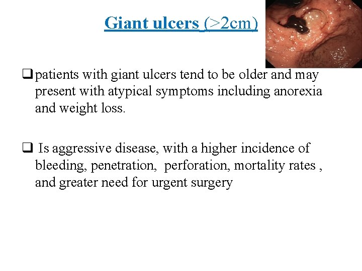 Giant ulcers (>2 cm) q patients with giant ulcers tend to be older and