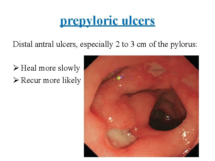 prepyloric ulcers Distal antral ulcers, especially 2 to 3 cm of the pylorus: Ø