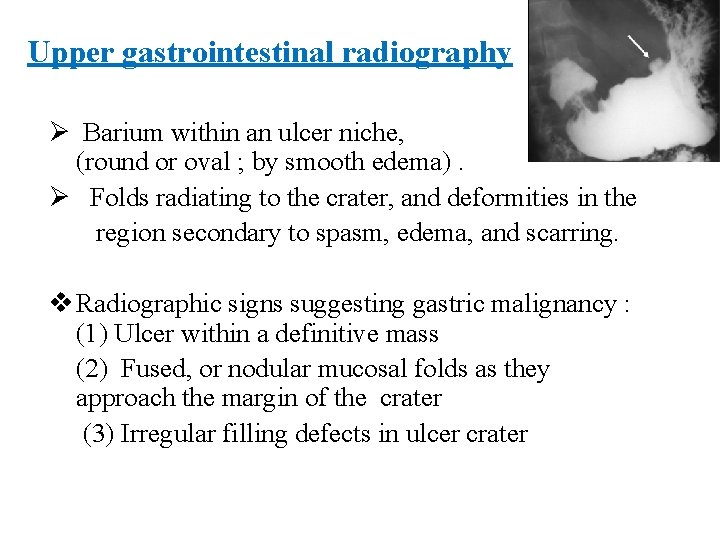 Upper gastrointestinal radiography Ø Barium within an ulcer niche, (round or oval ; by