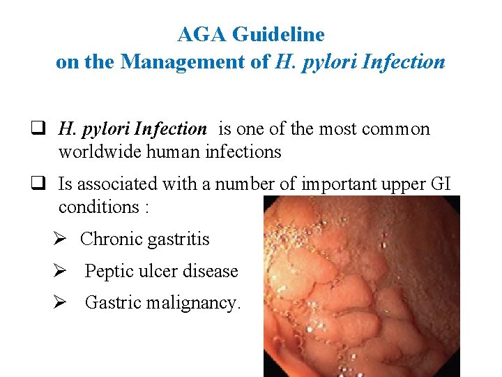 AGA Guideline on the Management of H. pylori Infection q H. pylori Infection is