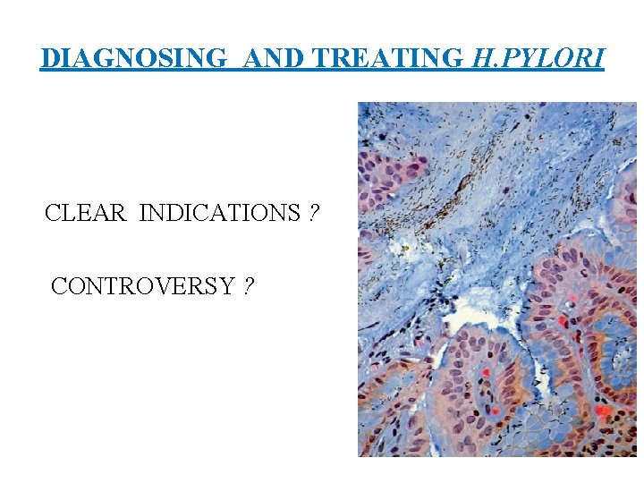 DIAGNOSING AND TREATING H. PYLORI CLEAR INDICATIONS ? CONTROVERSY ? 