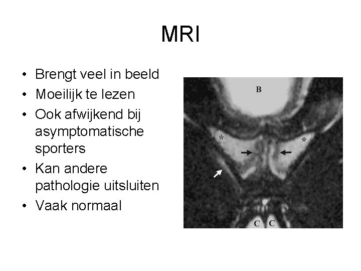 MRI • Brengt veel in beeld • Moeilijk te lezen • Ook afwijkend bij