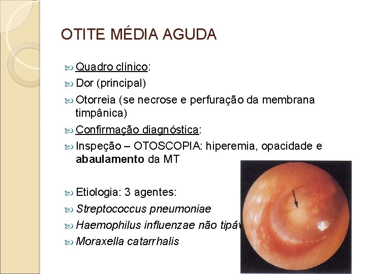 OTITE MÉDIA AGUDA Quadro clínico: Dor (principal) Otorreia (se necrose e perfuração da membrana