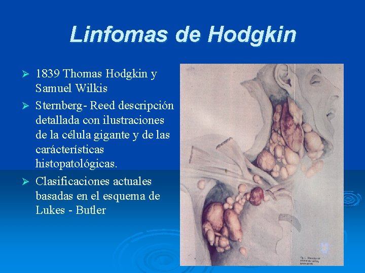 Linfomas de Hodgkin 1839 Thomas Hodgkin y Samuel Wilkis Ø Sternberg- Reed descripción detallada