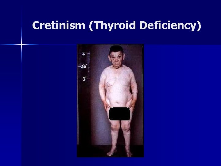 Cretinism (Thyroid Deficiency) 