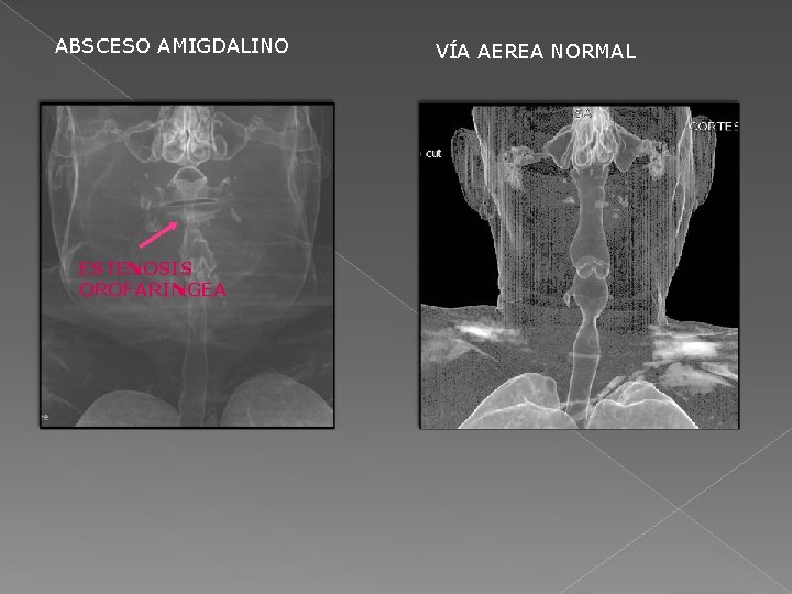 ABSCESO AMIGDALINO ESTENOSIS OROFARINGEA VÍA AEREA NORMAL 