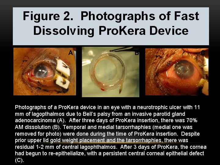 Figure 2. Photographs of Fast Dissolving Pro. Kera Device Photographs of a Pro. Kera