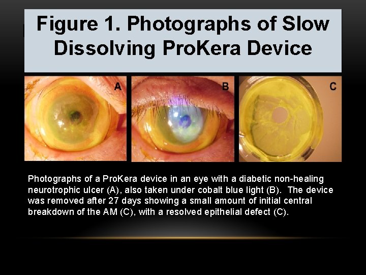 Figure 1. Photographs of Slow Dissolving Pro. Kera Device Photographs of a Pro. Kera