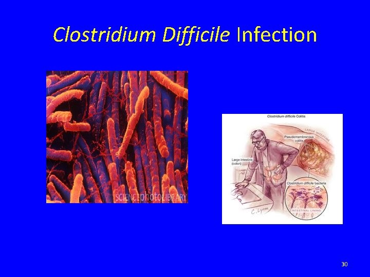 Clostridium Difficile Infection 30 