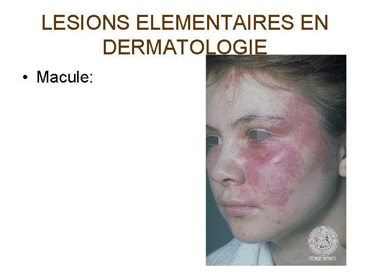 LESIONS ELEMENTAIRES EN DERMATOLOGIE • Macule: 