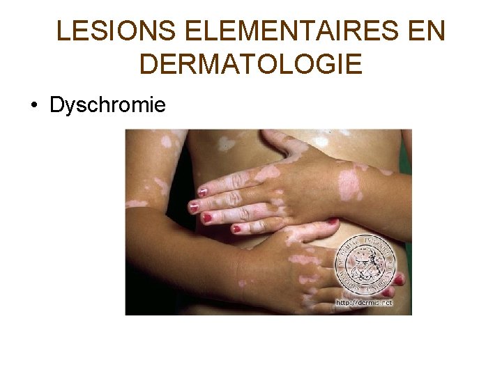 LESIONS ELEMENTAIRES EN DERMATOLOGIE • Dyschromie 